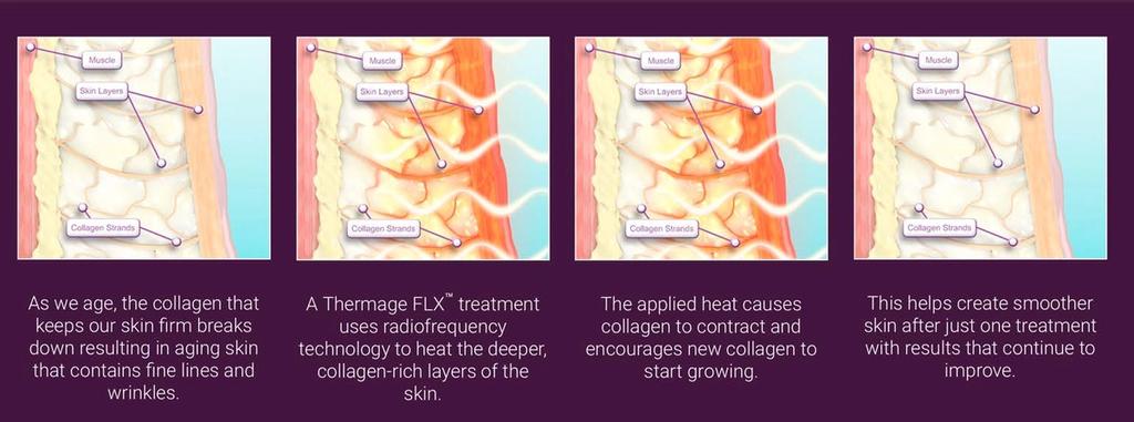 Steps on how Thermage FLX works