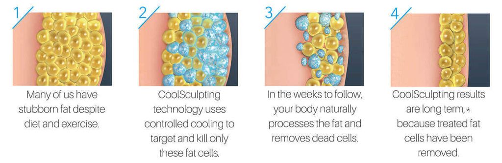 Steps on how Coolsculpt Fat Freezing works