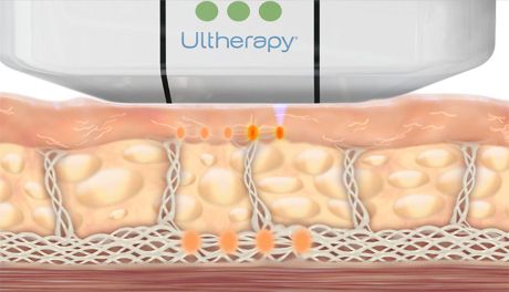 Ultherapy treating deep layers of skin