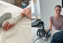 Gips više nije prepreka: Splitska poliklinika uvodi novu metodu liječenja prijeloma