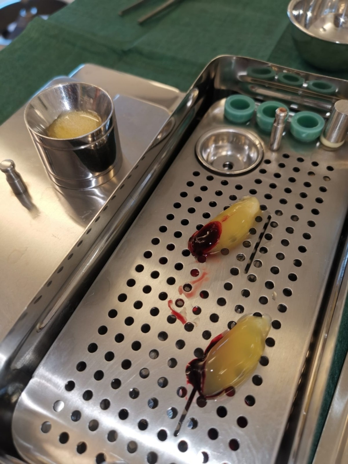 INOVATIVNA METODA Dr. Branimir Beus: Izliječili smo smrznuto rame