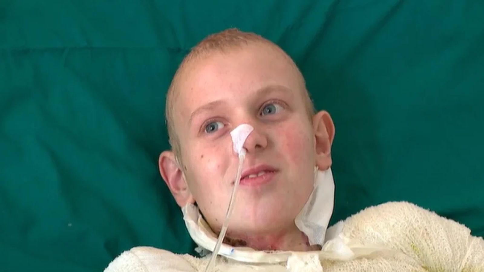 MEDICINSKO ČUDO Roko (15) je preživio strujni udar od 35.000 volti. Sad se vratio kući