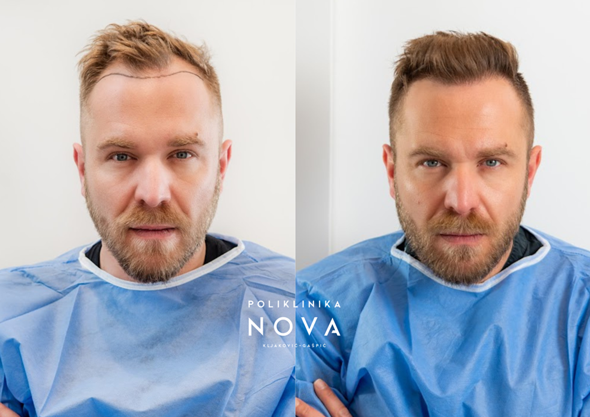 TRANSPLANTACIJA KOSE U SPLITU Dobro provjerite tko obavlja!