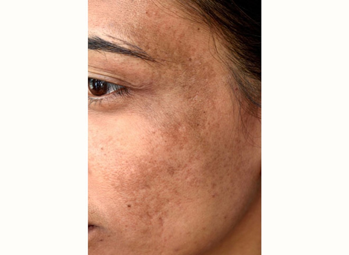 Kako se riješiti hiperpigmentacija na licu? 