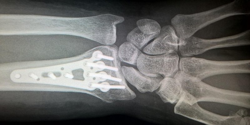 REVOLUCIJA U MEDICINI Kinezi izmislili ljepilo za slomljene kosti