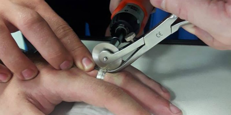 DOK IH VATROGASCI NE RASTAVE: Muškarac u Zadru nije mogao skinuti vjenčani prsten