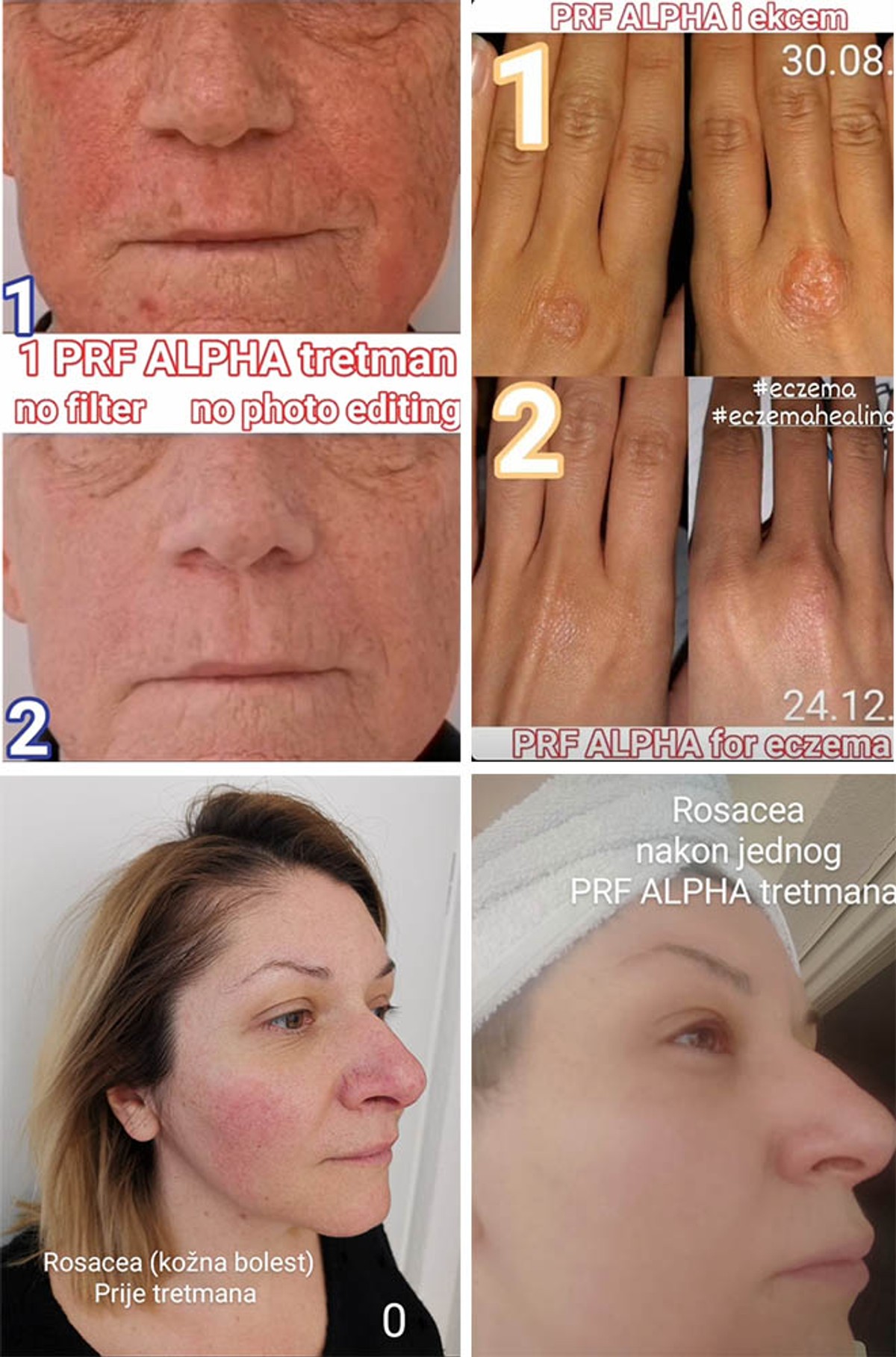 INOVATIVNA METODA Dr. Branimir Beus: Izliječili smo smrznuto rame