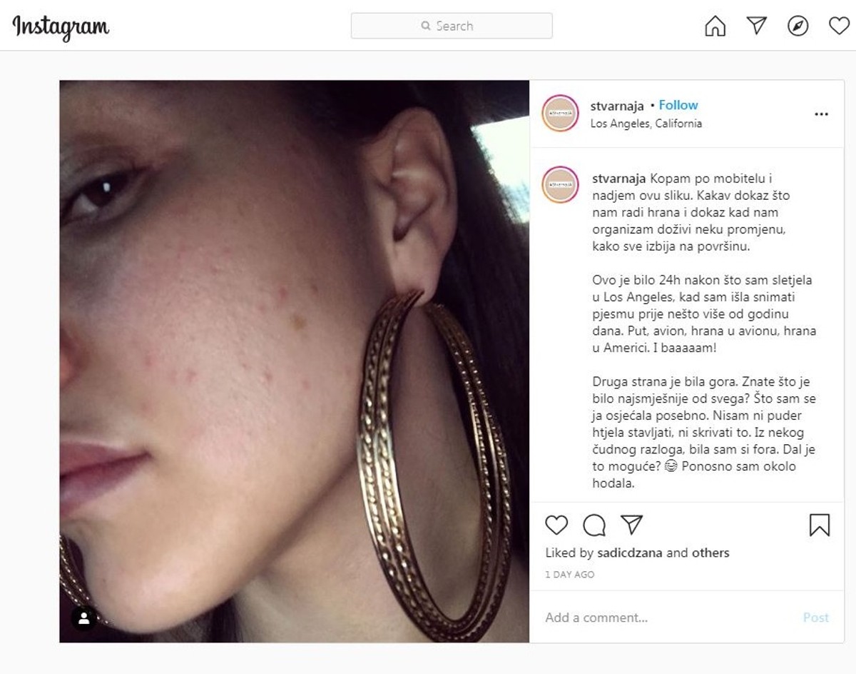 ODVAŽNO Lana nakon celulita objavila fotku prištavog lica
