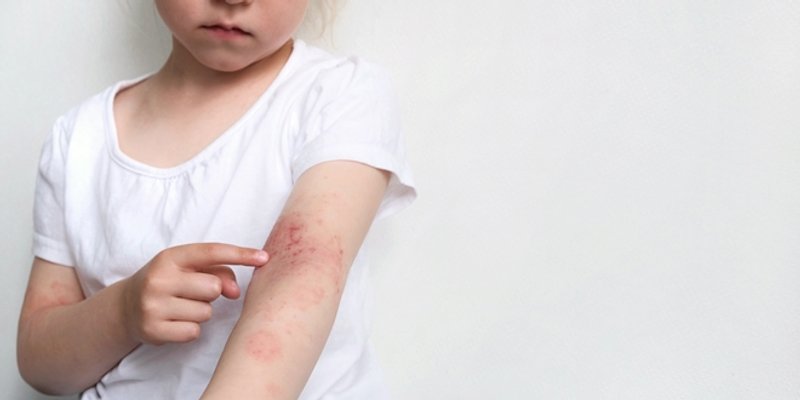 Crveni alarm na koži: Osipne bolesti i kako reagirati na vrijeme