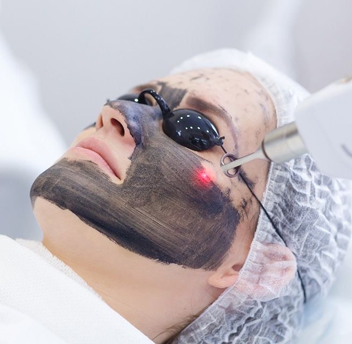 Carbon laser peel za ljepšu kožu u Skin Clinic centru