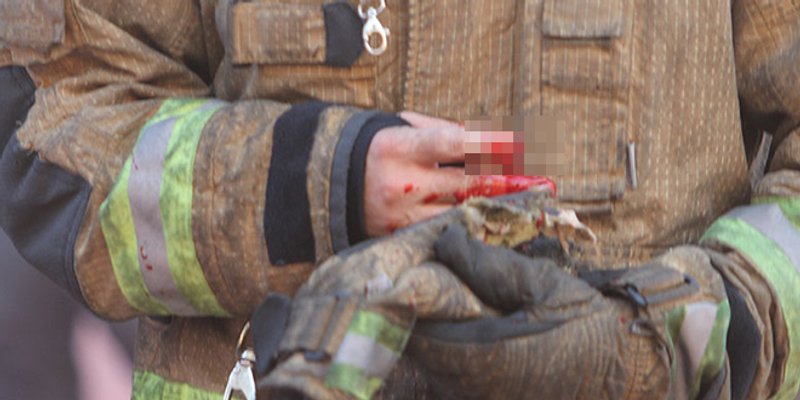 TEŠKA OZLJEDA: Vatrogasac od posljedica topovskog udara ostao bez dijela prsta