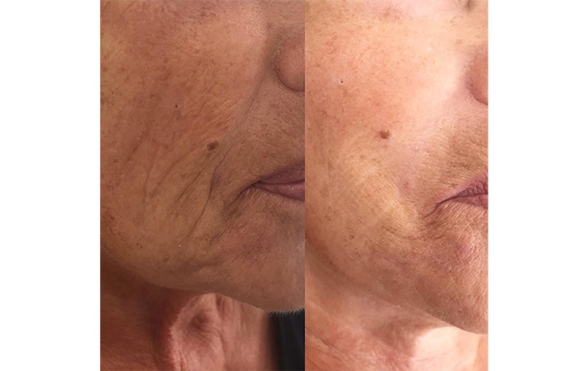 REGENERACIJA KOŽE NAKON ČETRDESETE Kako joj vratiti svježinu, volumen i fine linije? 