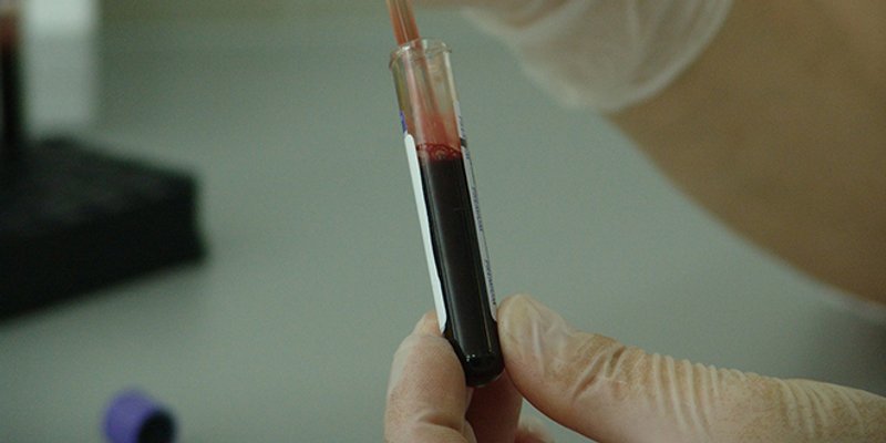 Dan multiplog mijeloma: Od teškog i rijetkog oblika raka krvi obolijeva sve više mladih 