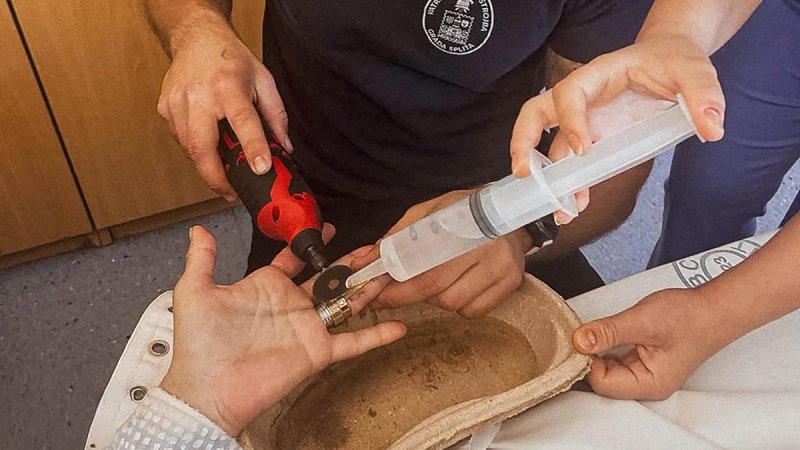 REKORD Vatrogasci u Splitu s jednog prsta uklonili čak četiri čelična prstena