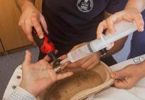 REKORD Vatrogasci u Splitu s jednog prsta uklonili čak četiri čelična prstena