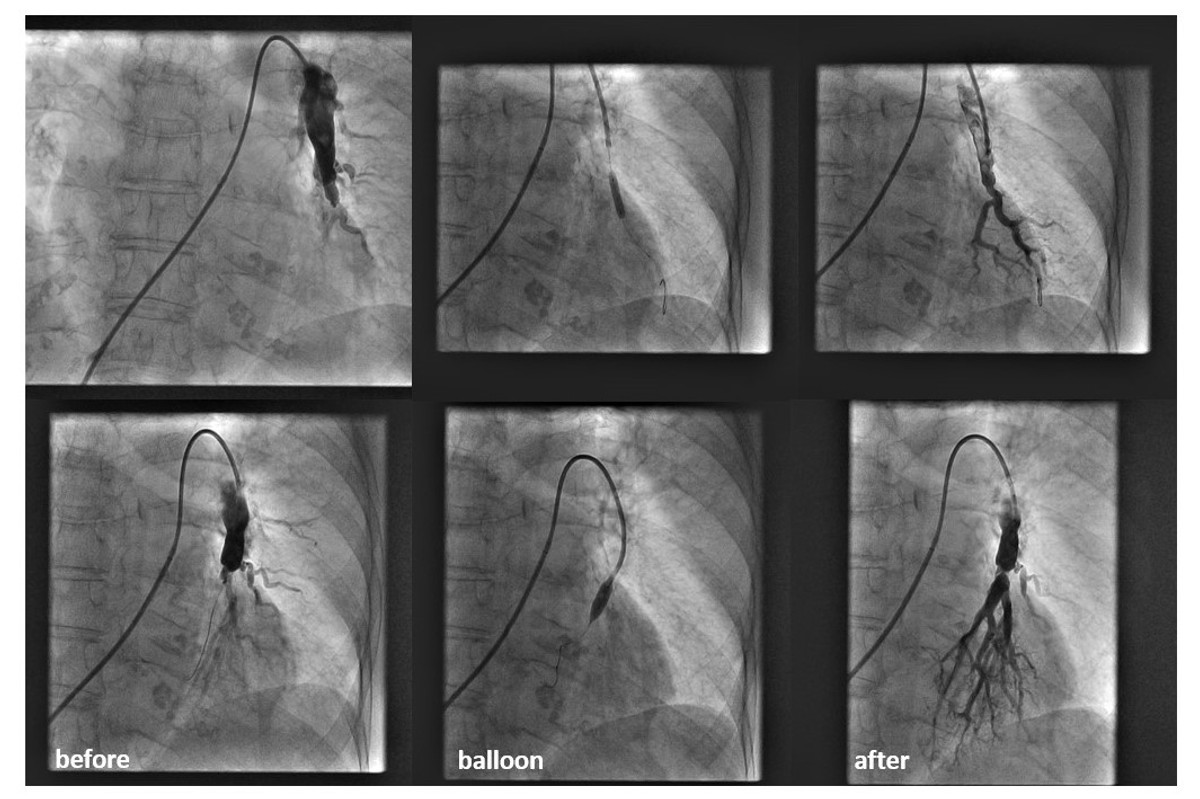KBC SPLIT: Izvedena prva balonska angiplastika plućnih arterija u CTEPH bolesnika u Hrvatskoj