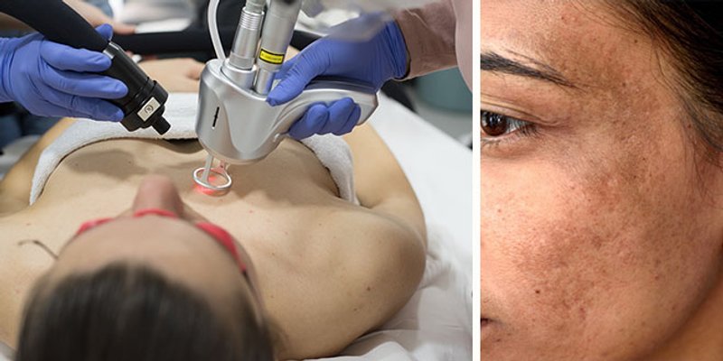 Kako se riješiti hiperpigmentacija na licu? 