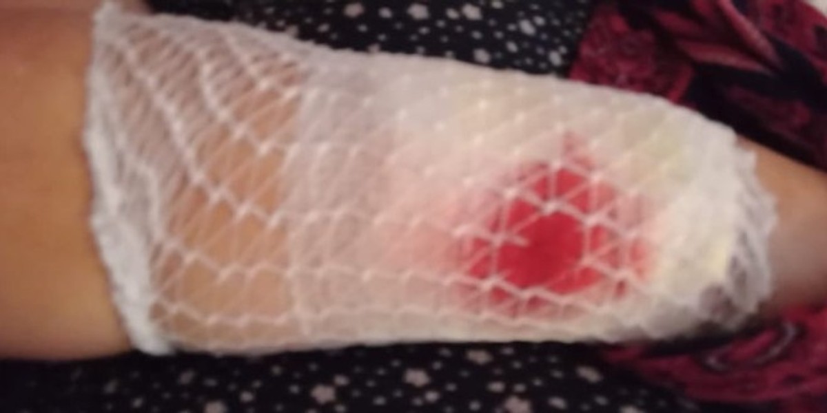 NA PLAŽI U KAŠTELIMA Ženu izgrizao pas dok je bila s unucima na moru