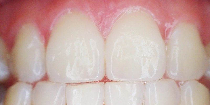 Znanstvenici otkrili zašto je ova bakterija vladar u našim ustima