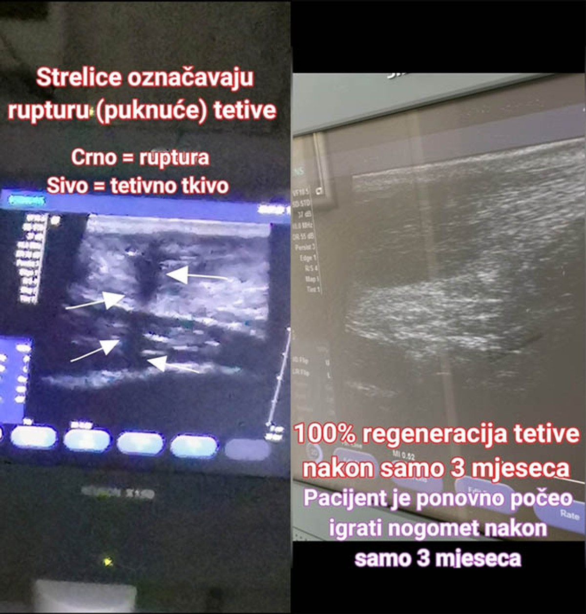 INOVATIVNA METODA Dr. Branimir Beus: Izliječili smo smrznuto rame