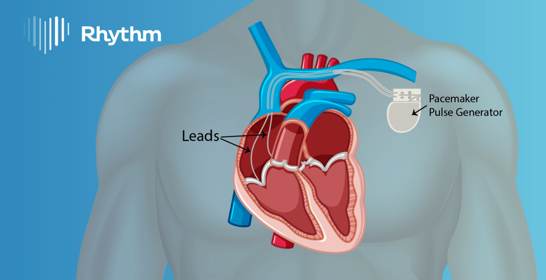 Understanding Pacemakers: Essential Insights for Patients