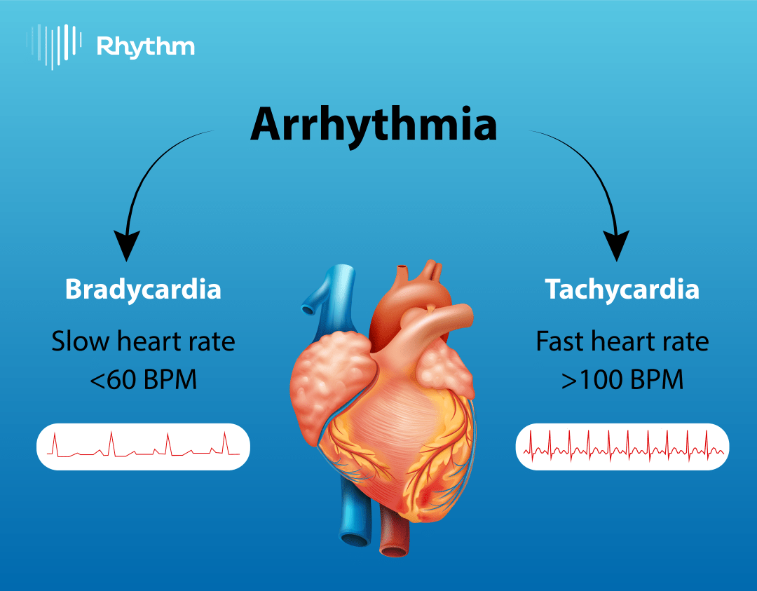 Arrhythmias: The Heart Rhythm Problems You Need to Know About