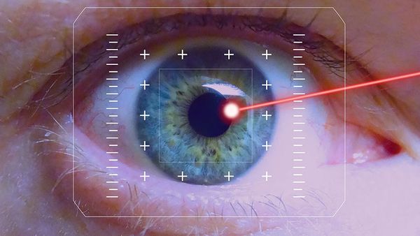 Laser Precision for Cataracts