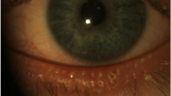 Dry Eye Management: Disease Treatment & Eye Drops