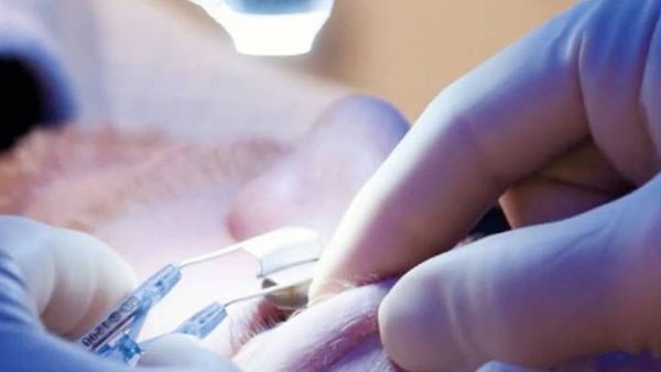 Everything You Need to Know About What Happens During LASIK Eye Surgery