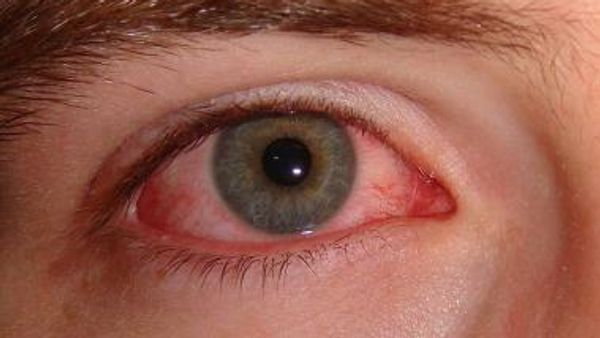 Viral Conjunctivitis