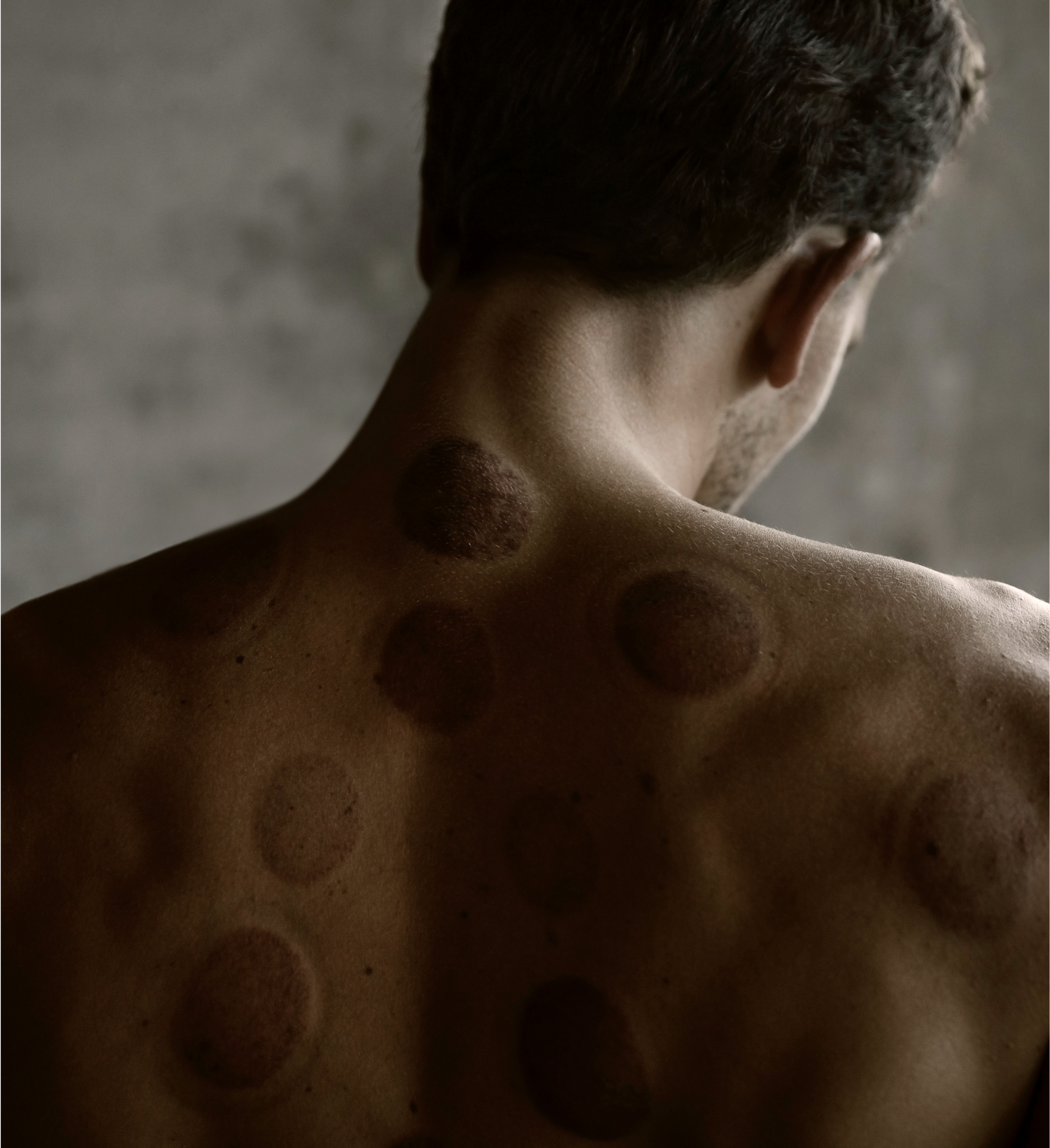 A man's back shows remnants of the cupping remedy