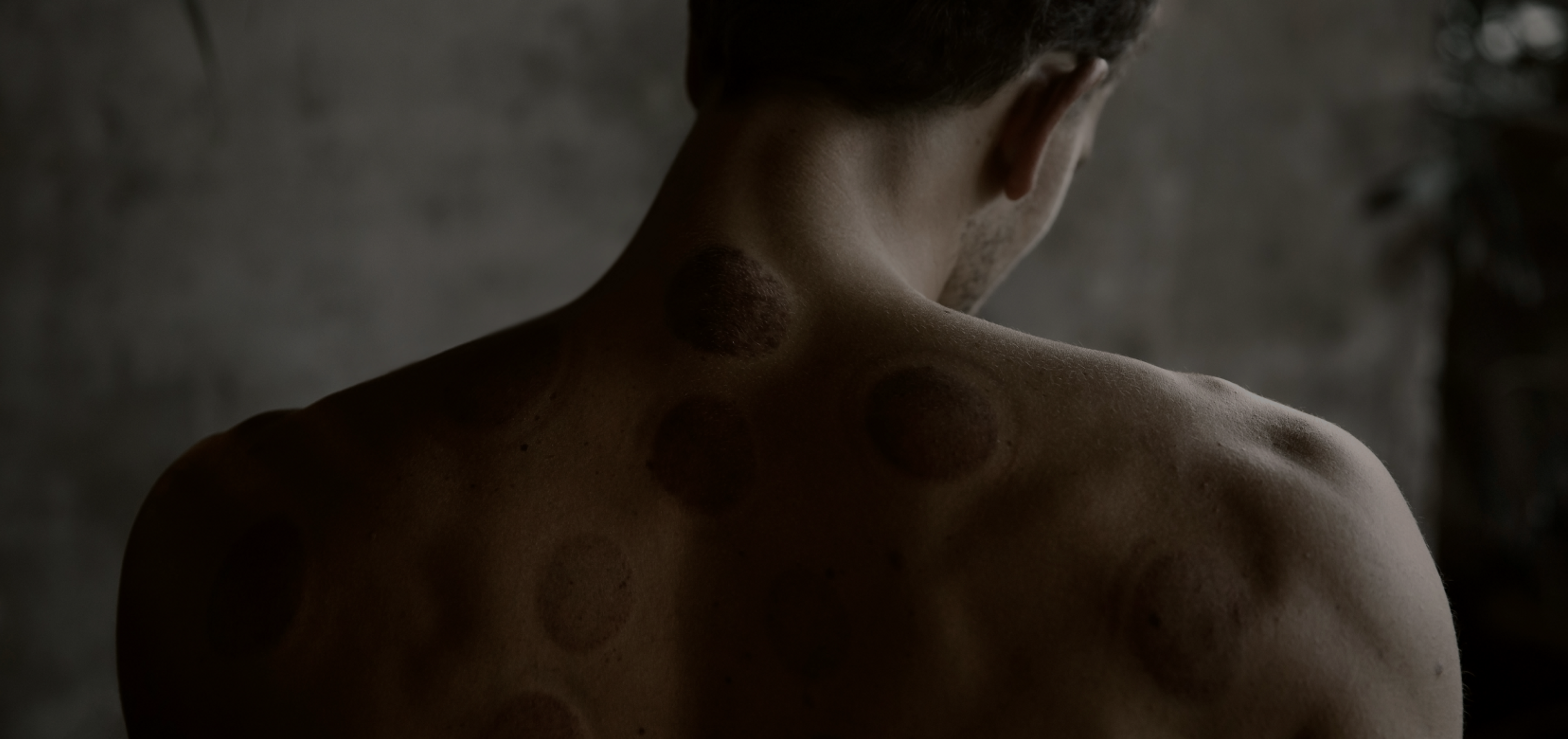 A man's back shows remnants of cupping remedy