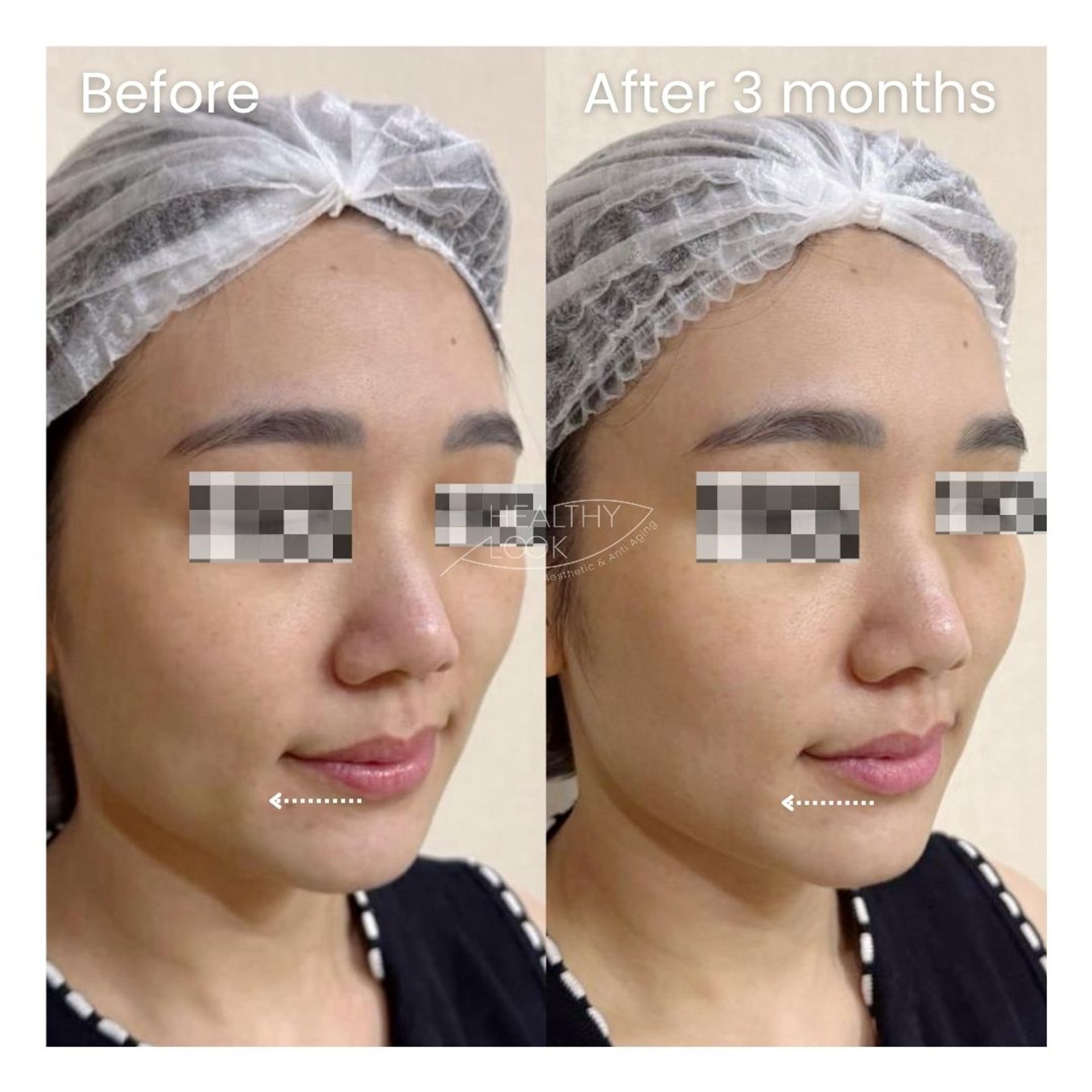 Before and after XERF Treatment at Healthy Look Aesthetic, Ubud