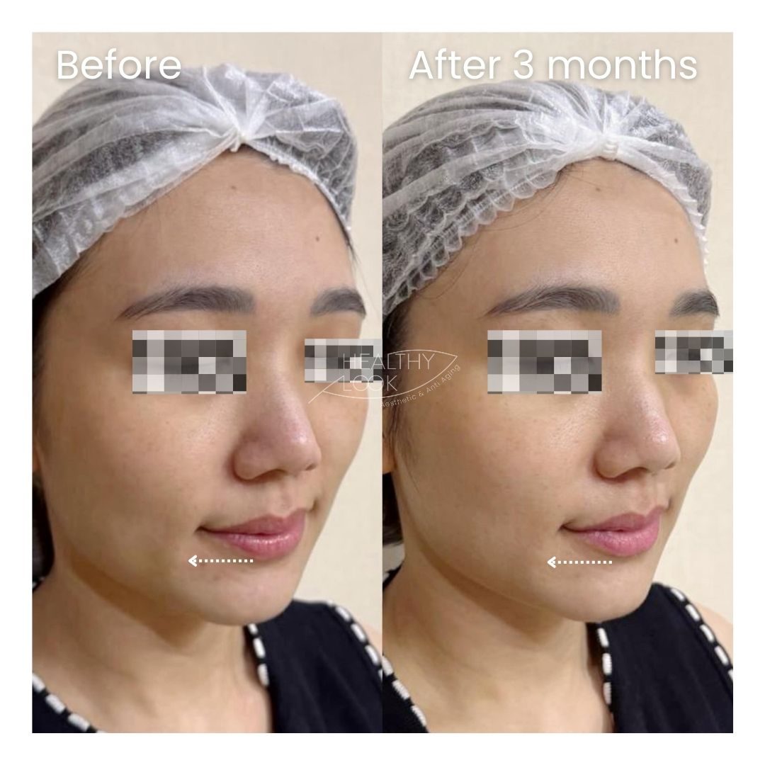 Before and after XERF Treatment at Healthy Look Aesthetic, Ubud