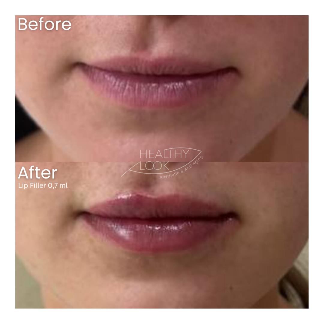 Before and after result 30 for Lip Filler treatment at Healthy Look Aesthetic