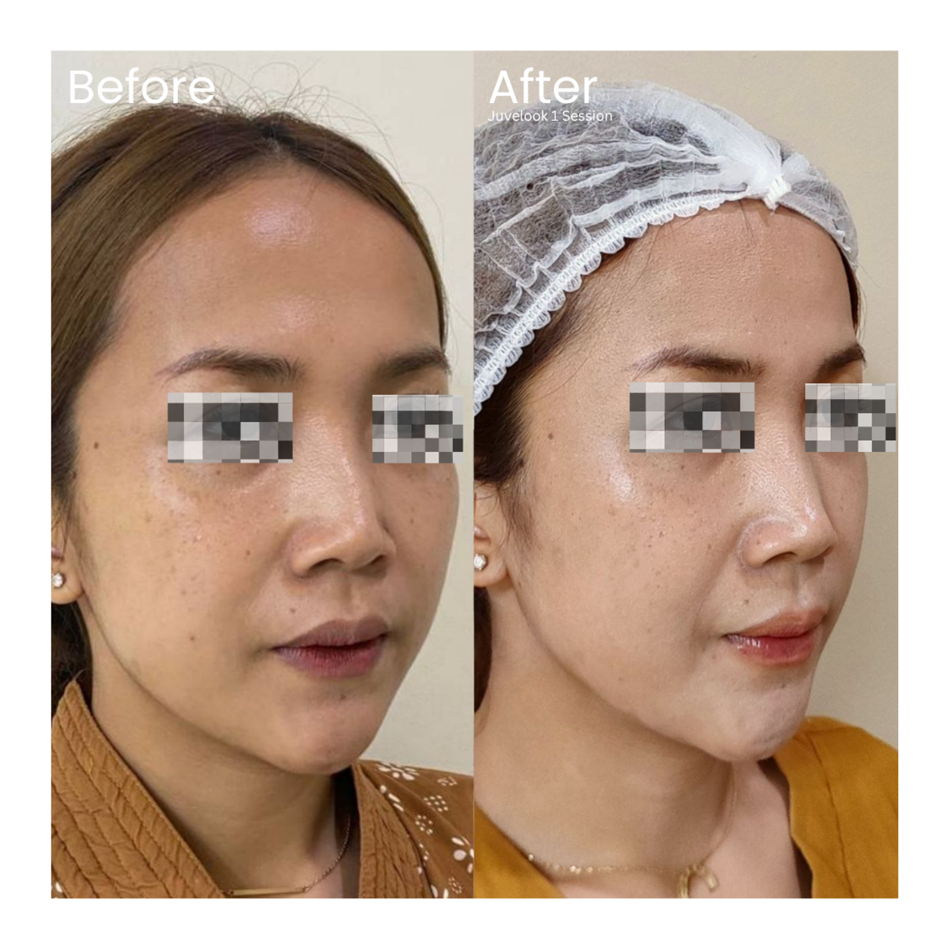 Before and after result 7 for Skin Treatment treatment at Healthy Look Aesthetic
