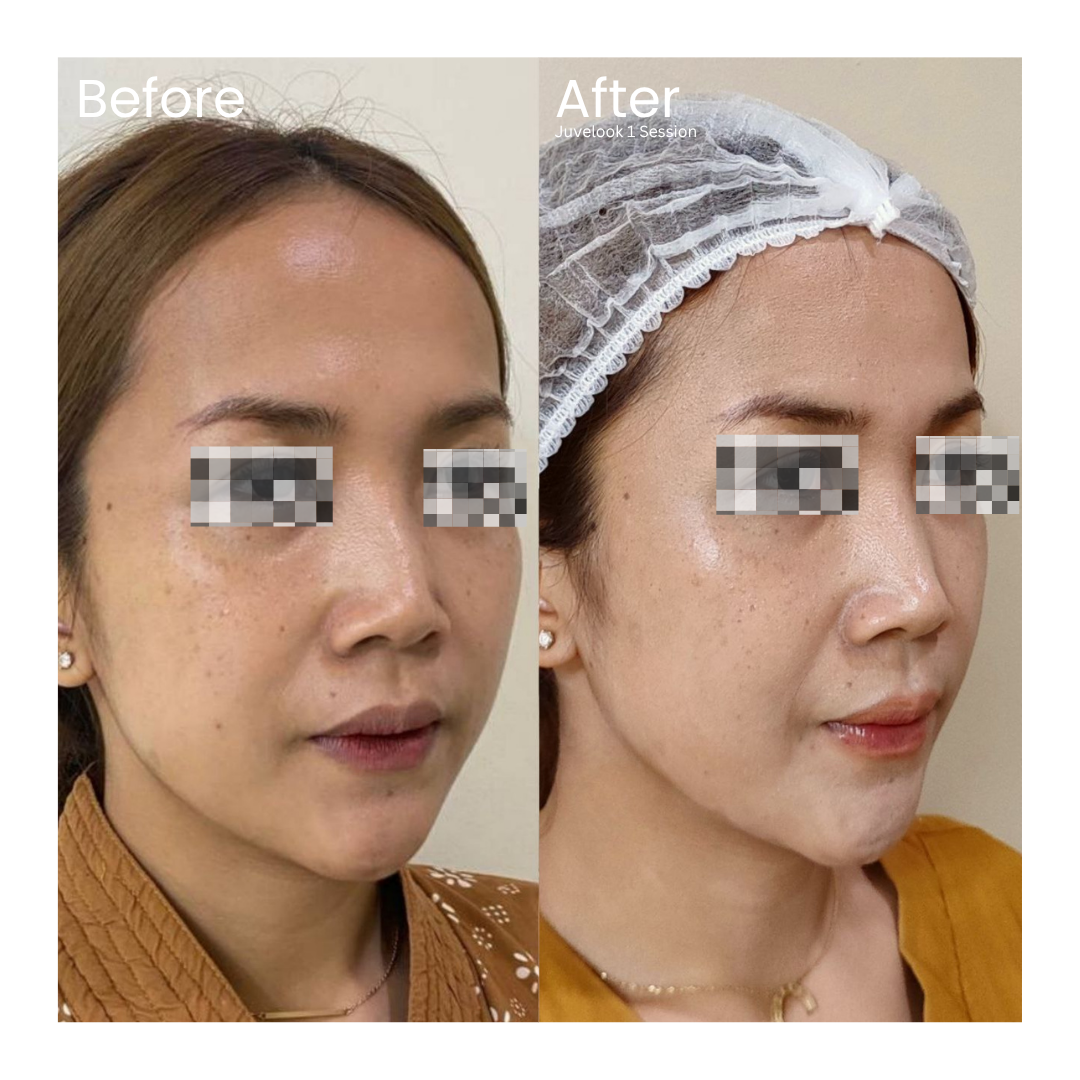 Before and after result 7 for Skin Treatment treatment at Healthy Look Aesthetic