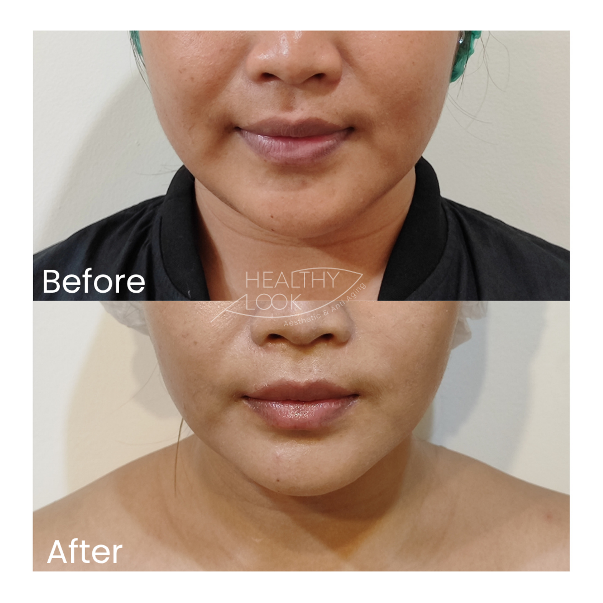 Before and after result 5 for Premium HIFU by Linear Z treatment at Healthy Look Aesthetic