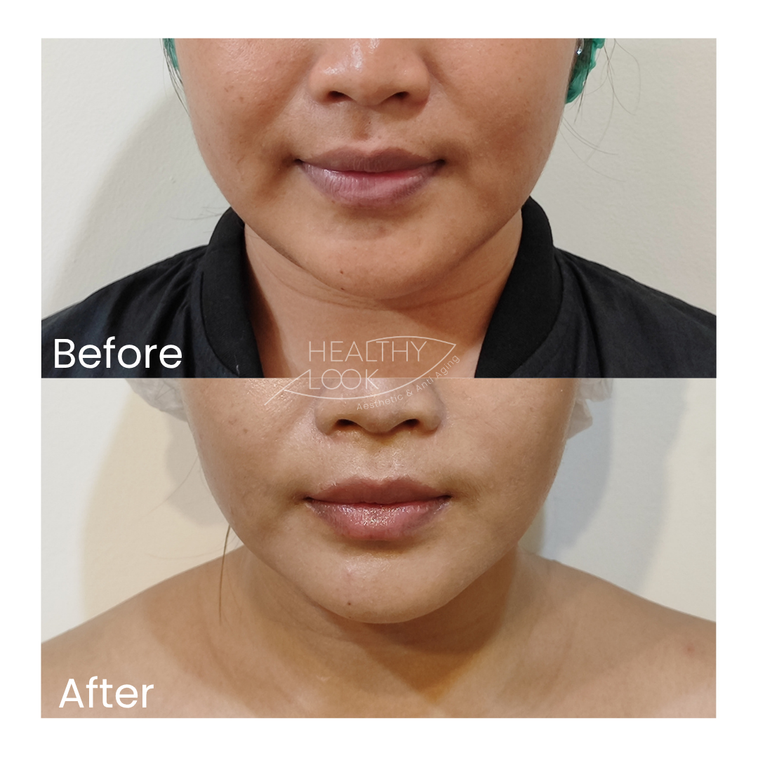 Before and after result 5 for Premium HIFU by Linear Z treatment at Healthy Look Aesthetic