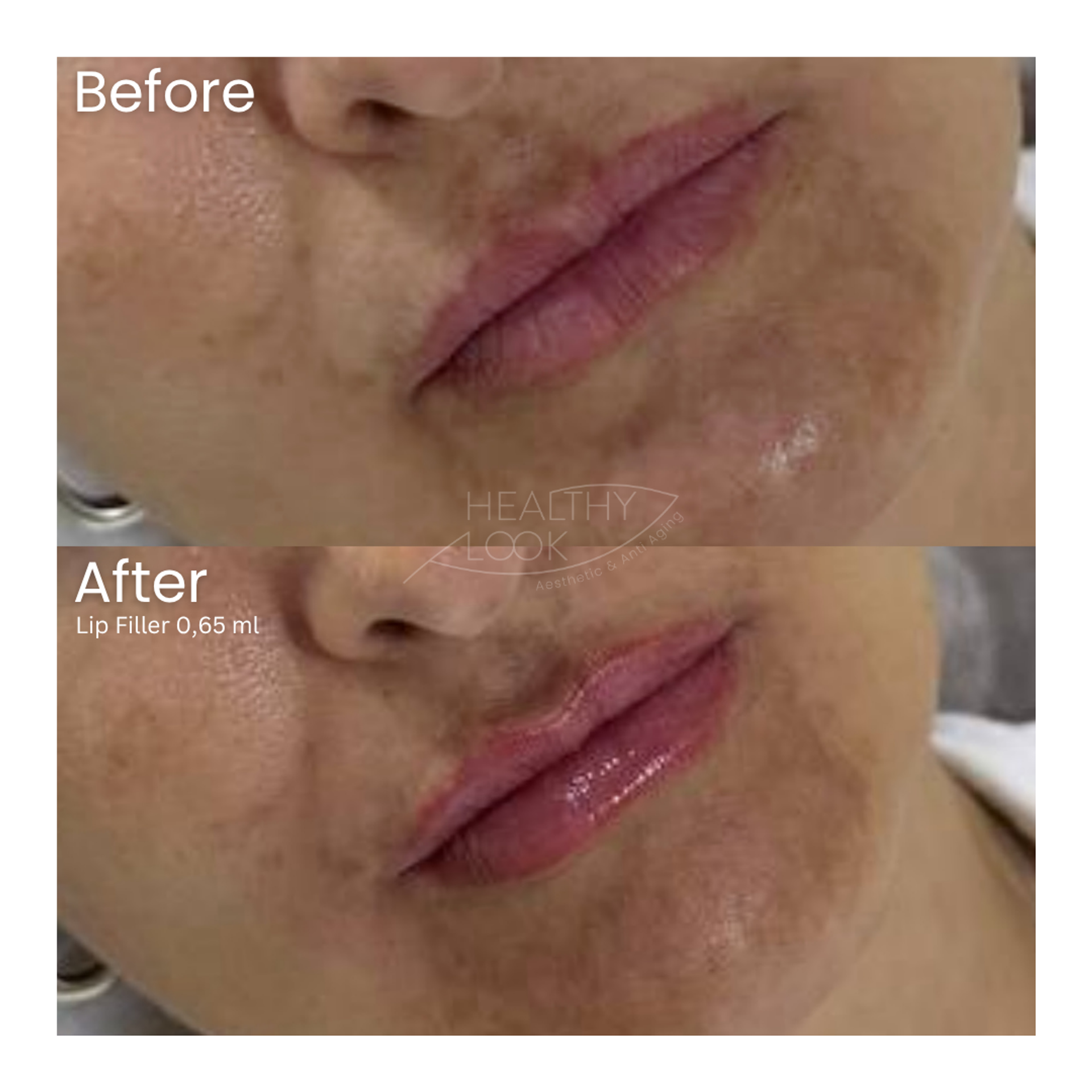 Before and after result 25 for Lip Filler treatment at Healthy Look Aesthetic