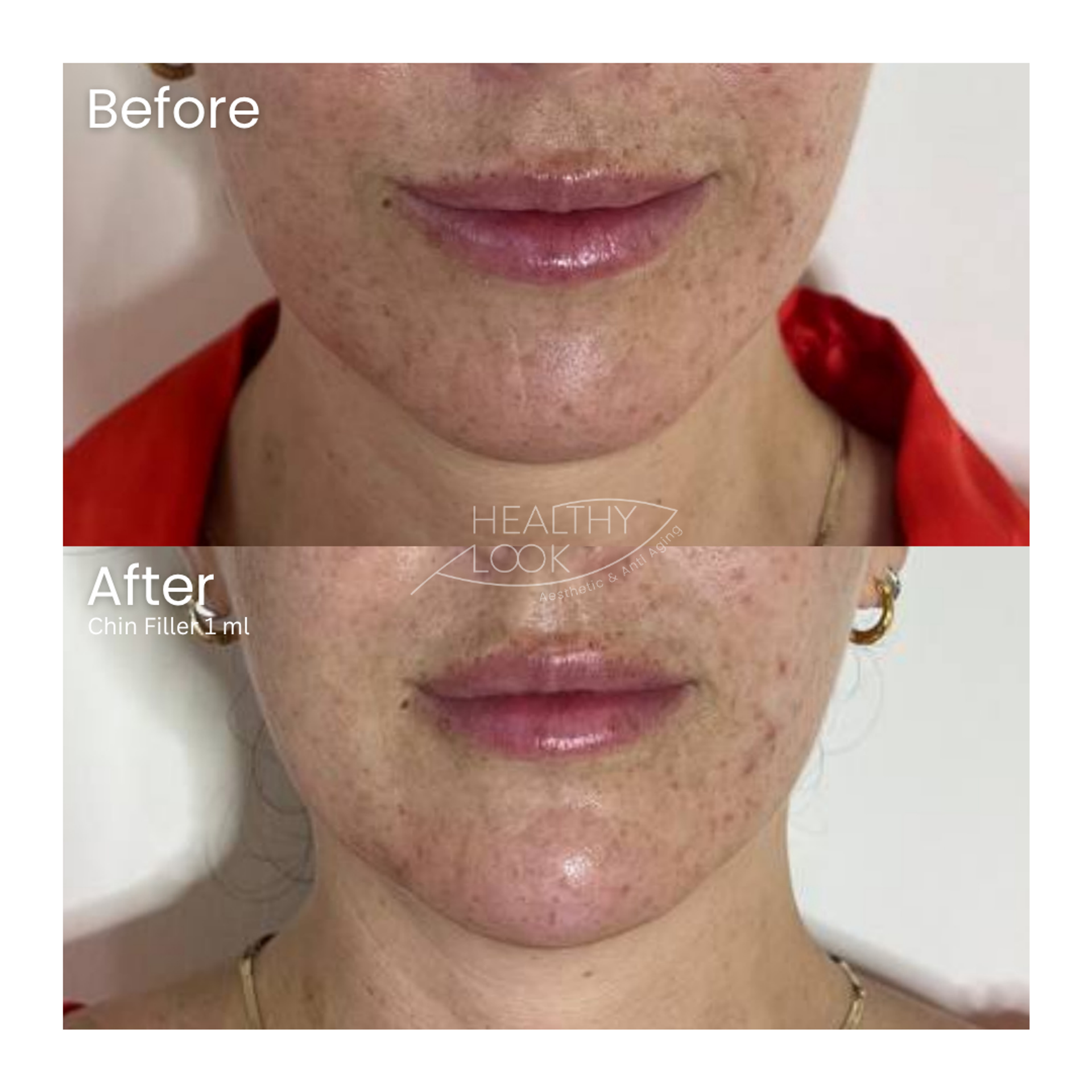 Before and after result 8 for Dermal Filler treatment at Healthy Look Aesthetic
