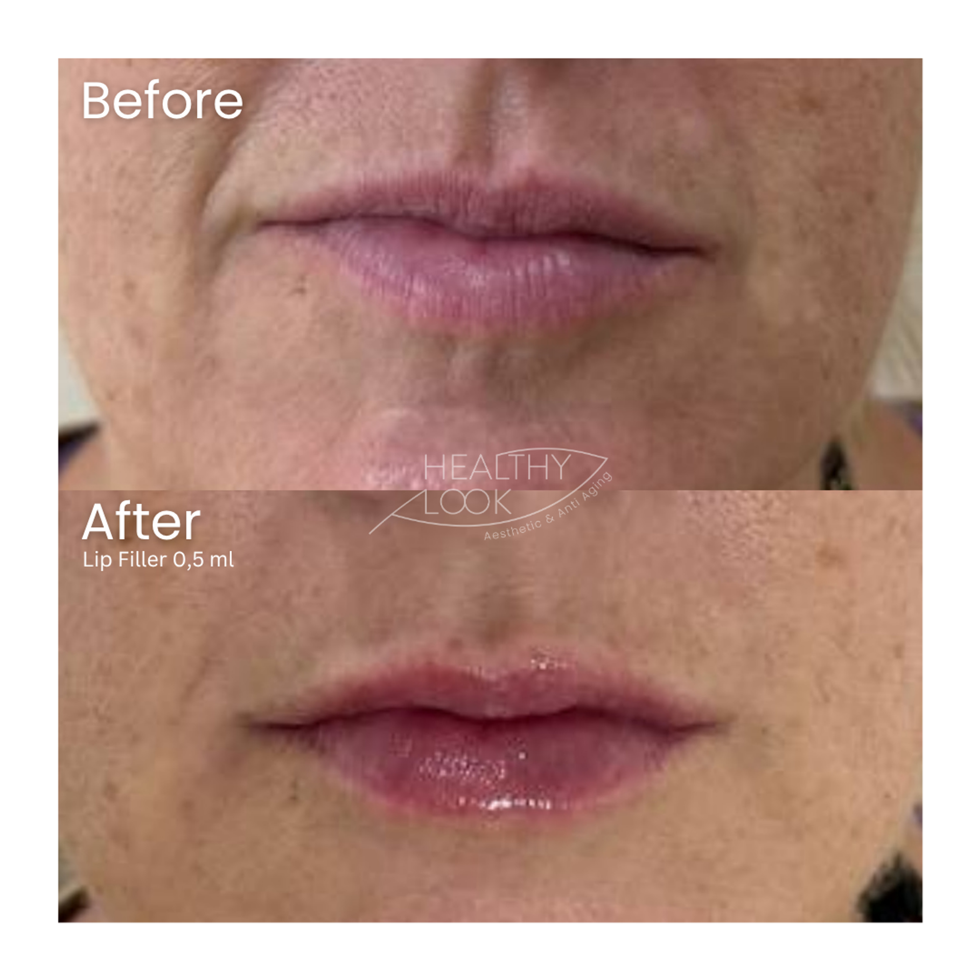 Before and after result 23 for Lip Filler treatment at Healthy Look Aesthetic