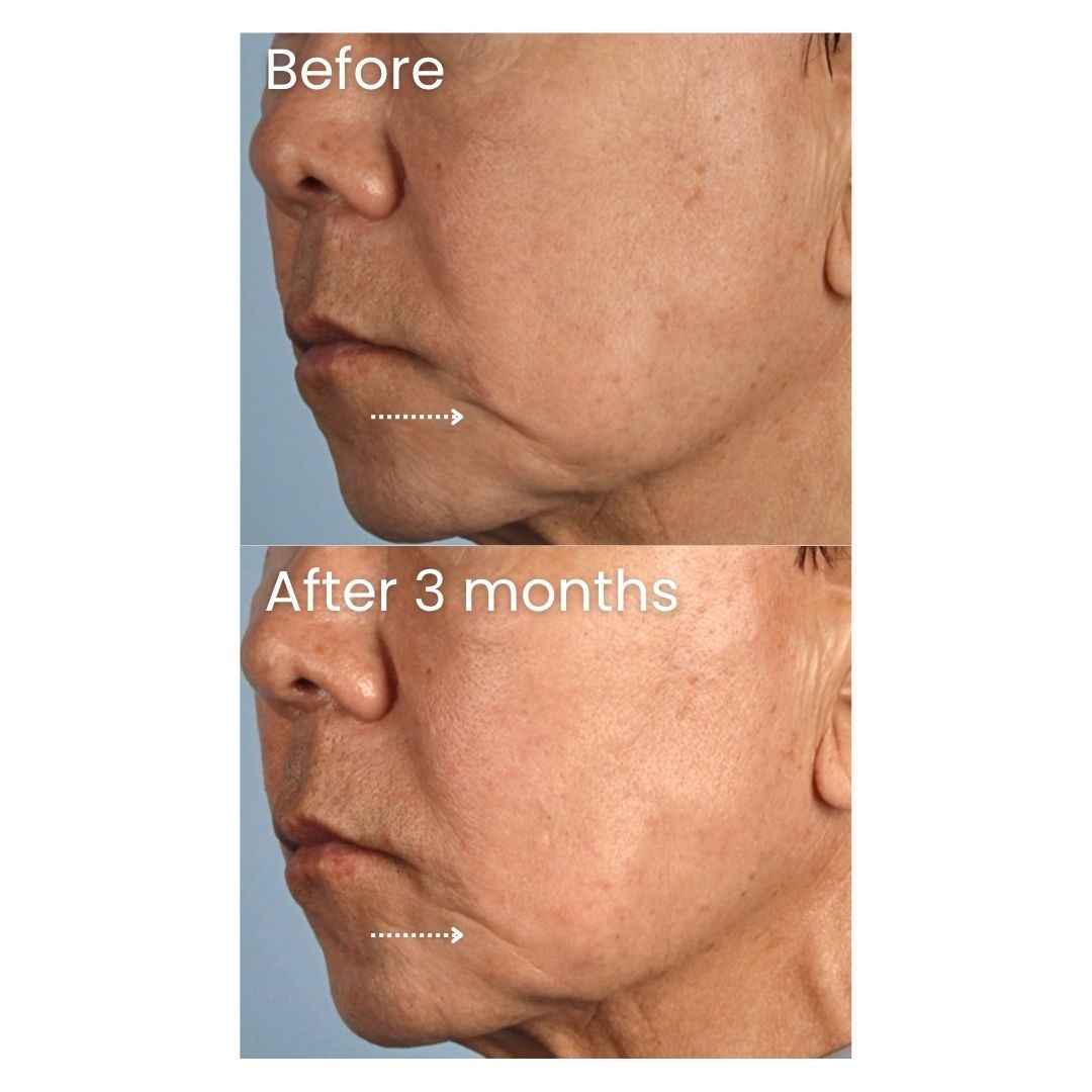 Before and after XERF Treatment at Healthy Look Aesthetic, Ubud