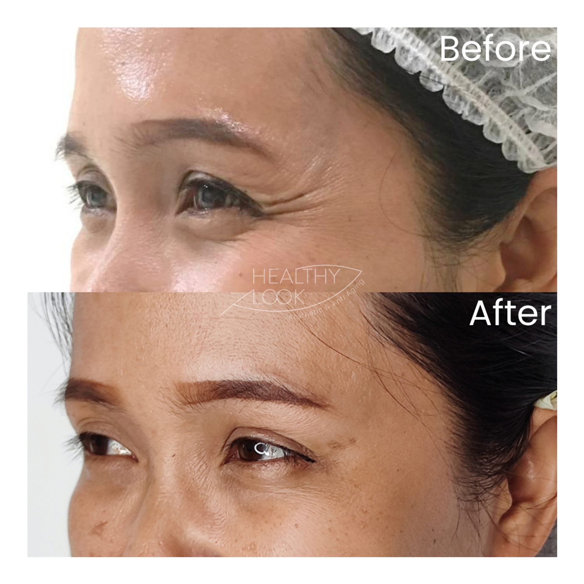 Before and after result 12 for Botox treatment at Healthy Look Aesthetic
