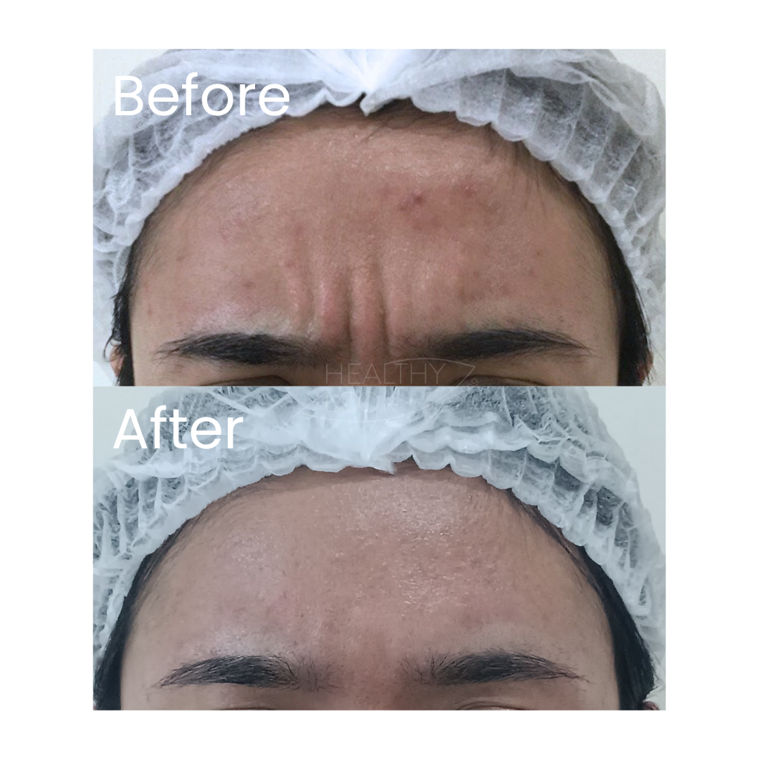 Before and after result 15 for Botox treatment at Healthy Look Aesthetic