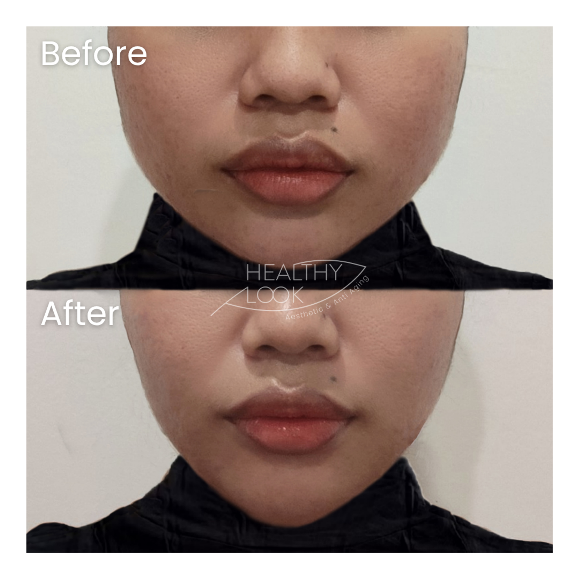Before and after result 8 for Premium HIFU by Linear Z treatment at Healthy Look Aesthetic