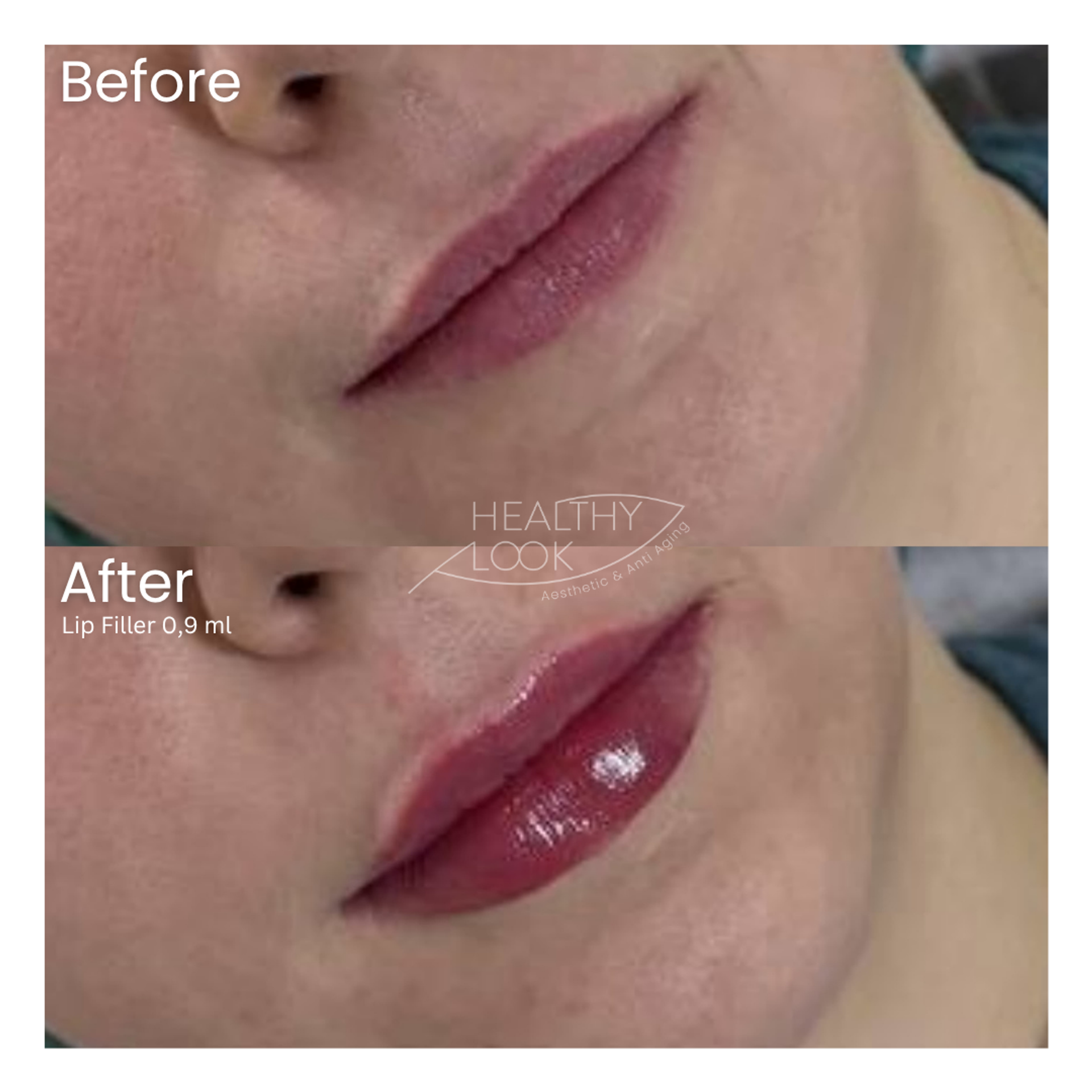Before and after result 33 for Lip Filler treatment at Healthy Look Aesthetic