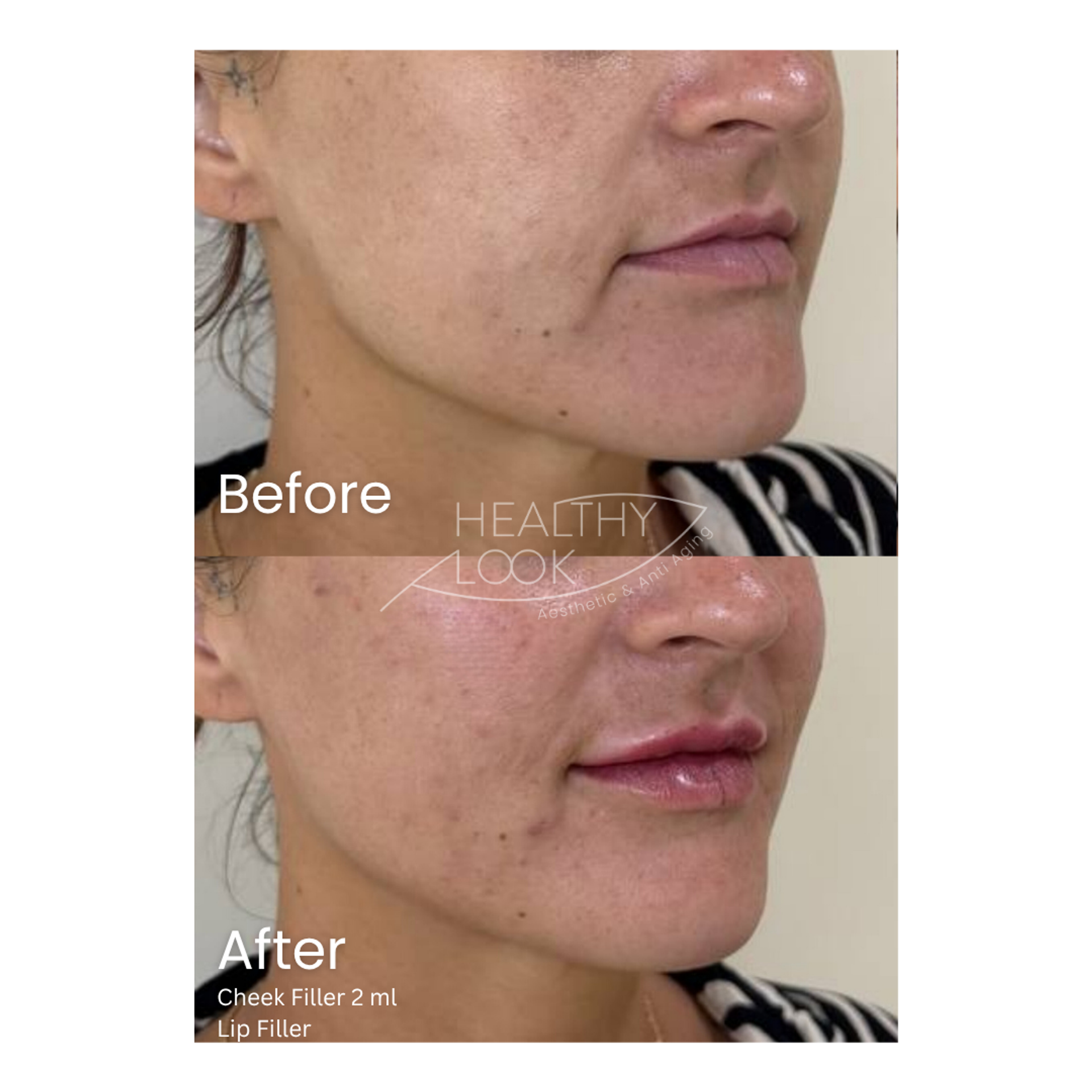 Before and after result 12 for Dermal Filler treatment at Healthy Look Aesthetic