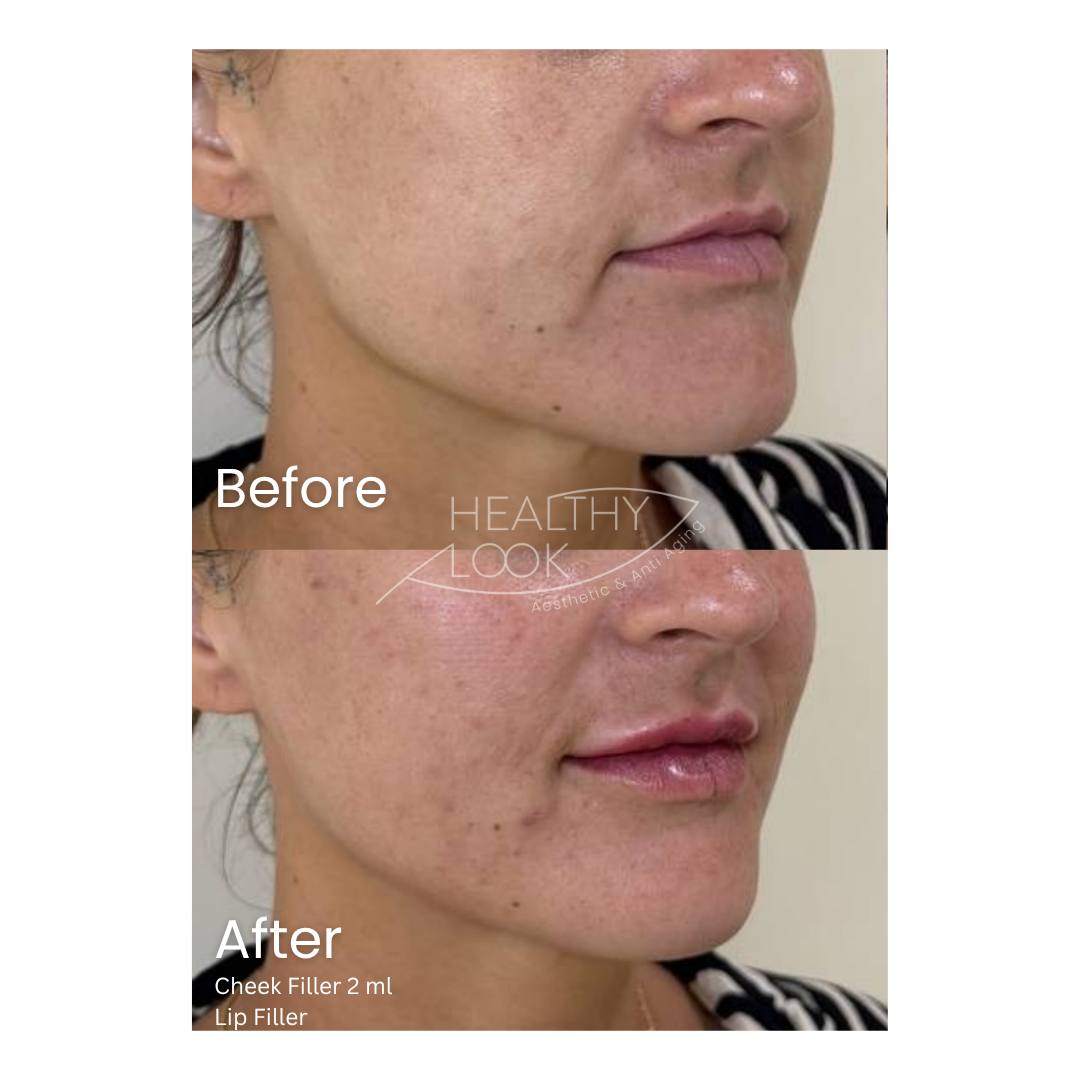 Before and after result 12 for Dermal Filler treatment at Healthy Look Aesthetic