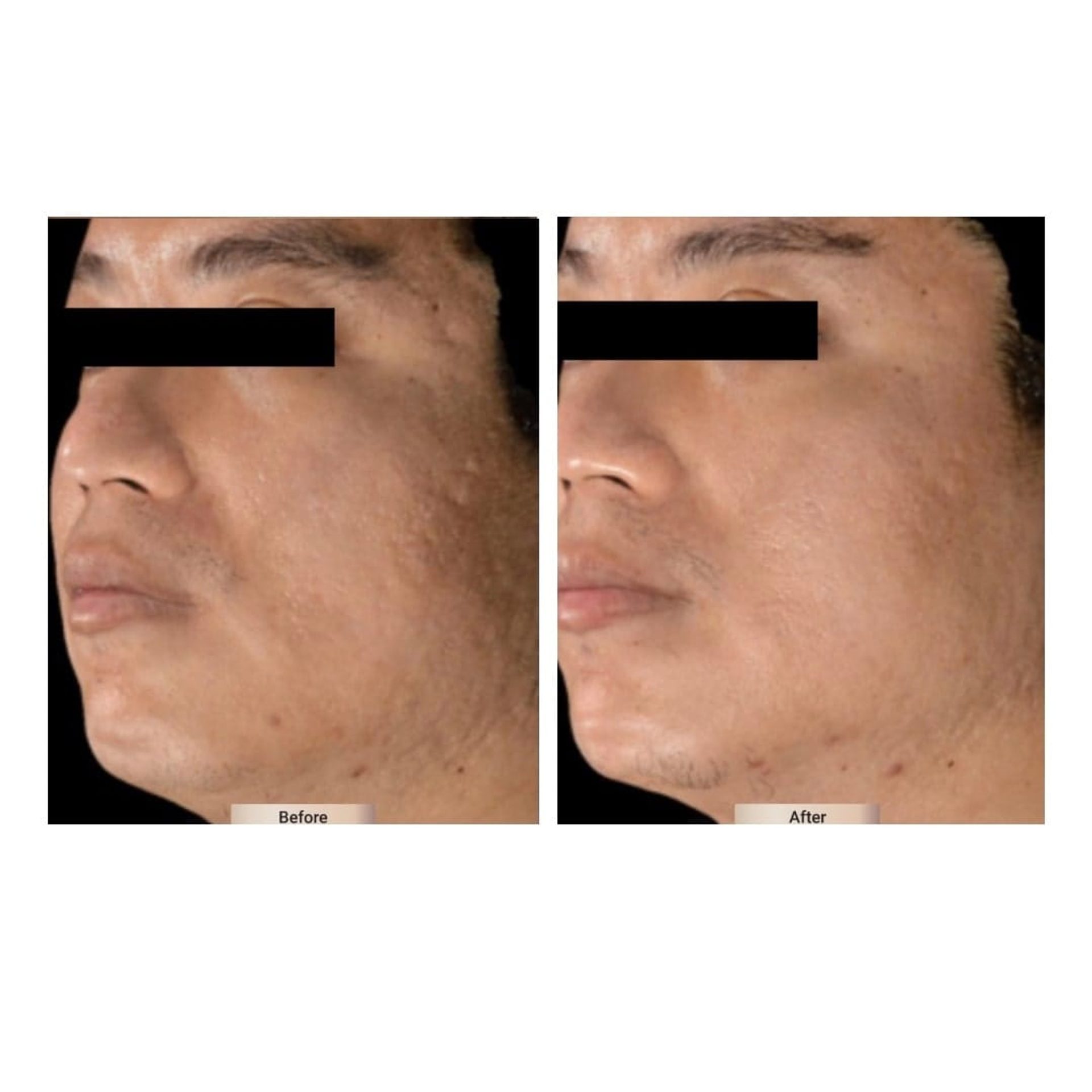 Before and after result 3 for Sylfirm X treatment at Healthy Look Aesthetic
